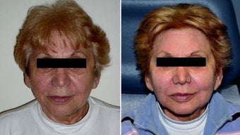 Panfacial Filler before 185799