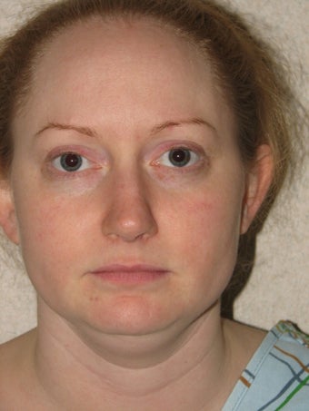 Smartlipo of the Neck and Jowls before 316496