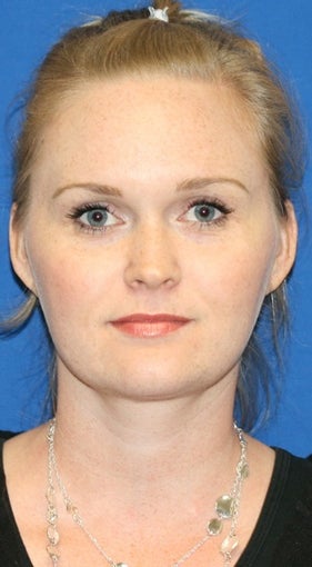 1 month post op: Necklift & Neck Liposuction 480354