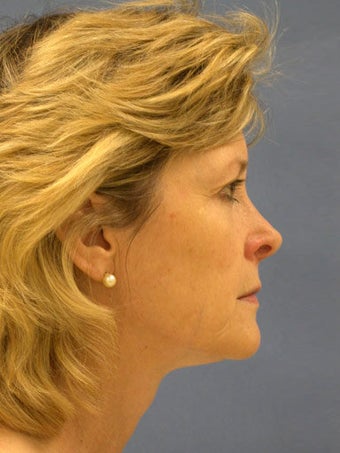 Facelift, Endoscopic Browlift, Upper and Lower Blepharoplasty, Lip Augmentation with Alloderm Grafts before 248834