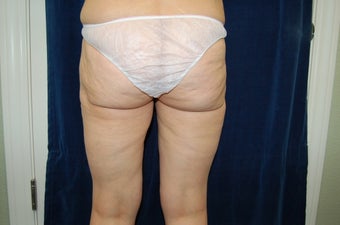 Bi-lateral thigh and buttocks lift with fat transfer before 284106