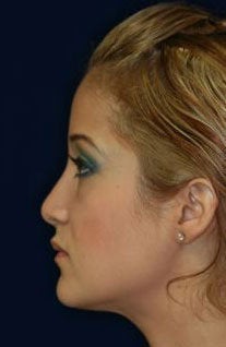 Rhinoplasty and Septoplasty after 223643