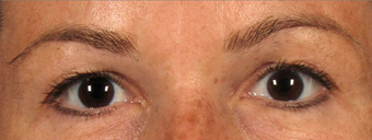 Upper Eyelidplasty with TCA Peel Lower Lids before 420542