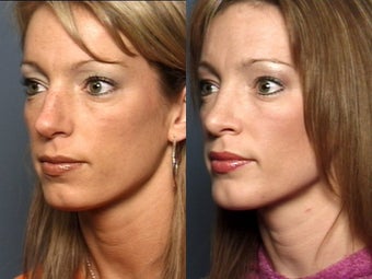 Nose Surgery before 338485