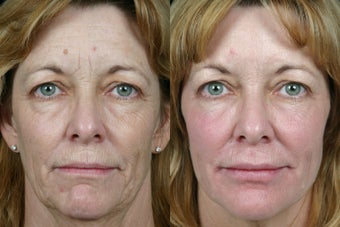 Pearl Fractional before 310786
