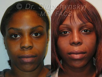 African American Rhinoplasty 609011
