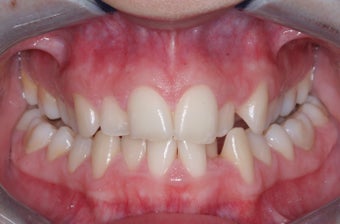 Invisalign before 372763