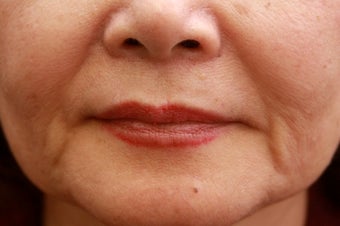 Fill the nasolabial folds and marionette lines before 508924