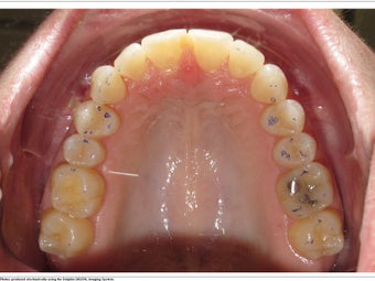 Invisalign 362339