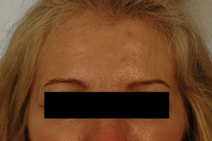 Coreecting Asymmetry with Botox (Dysport Browlift). after 649422