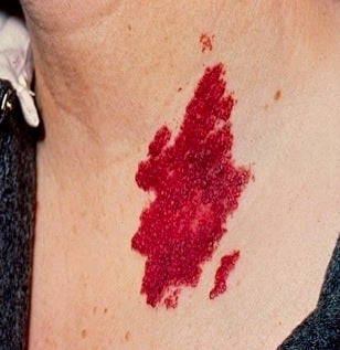 PDL for port wine stain before 374578