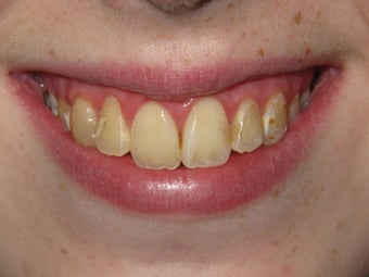 Kor Whitening before 405631