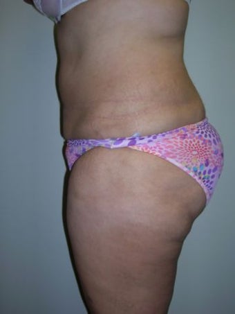 Liposuction after 258663