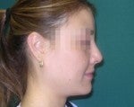Nose Surgery -Rhinoplasty 519261