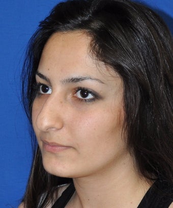 Rhinoplasty before 373763