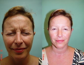 Botox in the corrugator muscle. before 555904