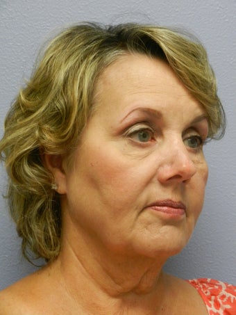 Neck Lift before 598886