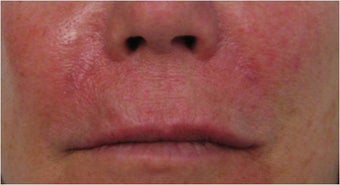 Juvederm to nasolabial folds after 77468