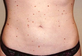 Liposuction after 200786