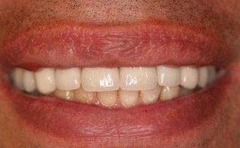 Full Porcelain Crowns after 145680