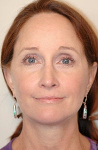 Mini face lift with endoscopic brow lift after 70987