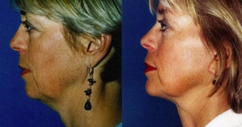 Facelift before 633504