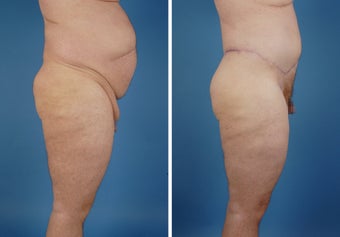 Upper & Lower Body Lift 335976