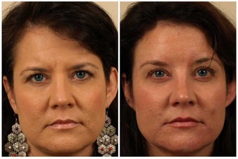 Browlift before 341130