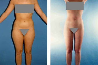 Liposuction before 636164