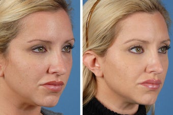 Botox Cosmetic & Restylane 356613