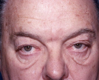 Blepharoplasty before 322229