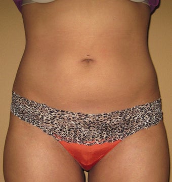 liposuction after 269322