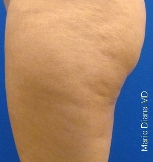 Cellulaze after 582371