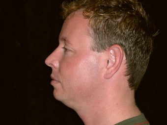 Necklift before 236061