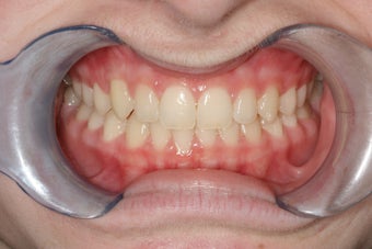 Underbite, Grummons Facemask after 296517