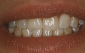 Teeth Whitening before 485396