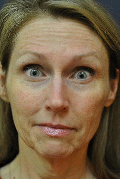 Botox before 622160