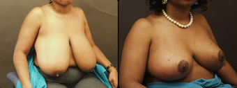 Breast Reduction after 160572
