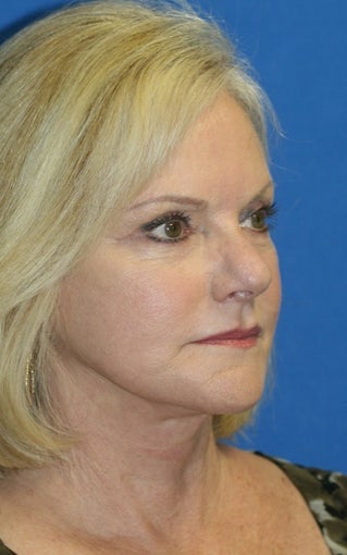 Short Incision Facelift and Lateral Browlift after 392435