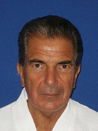 Facelift, Endoscopic Browlift, Upper and Lower Blepharoplasty with canthopexy. before 249291