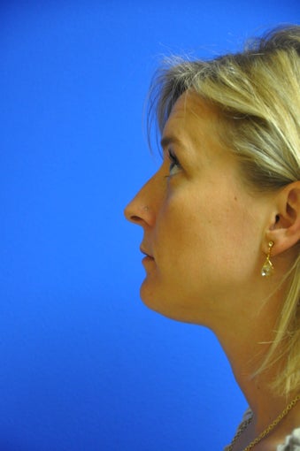 Nasal airway surgery with cosmetic improvment before 478783