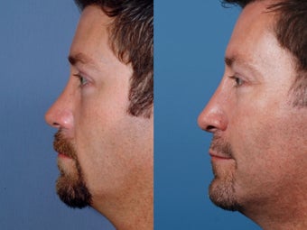 Revision rhinoplasty after 355697