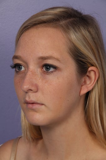 Chin Augmentation and Liposuction of the Neck after 611675