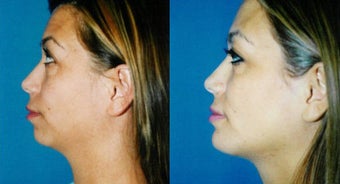 Chin Augmentation before 565891