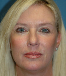 Mini Lift, Eyelid and Brow Lift Surgery after 324009