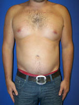 Pec Implants after 130081