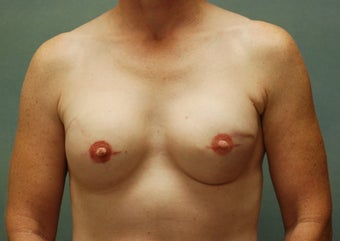Breast Reconstruction after 221548