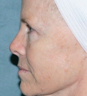 Laser resurfacing before 376147