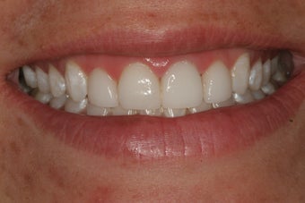 Simple Smile Design with gum lift and porcelain veneers after 92911