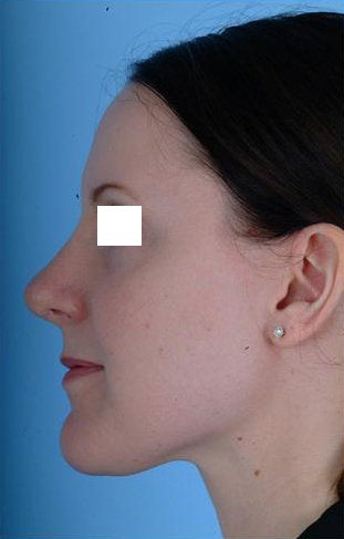 Revision Rhinoplasty after 100950
